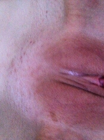 "Check out this gross as fuck shot of some dude's dick, lookin all infected and shit. Like puss-filled pimples and scabs everywhere."